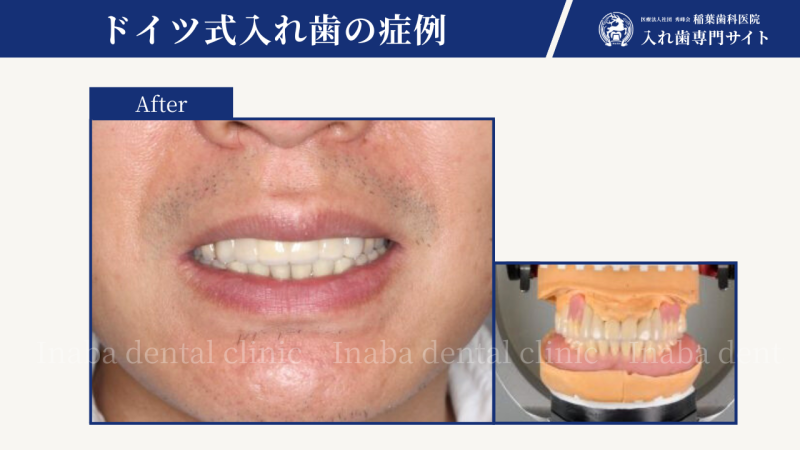 歯がぐらつき、噛むと痛みがある〜コーヌスクローネで治療した症例〜
