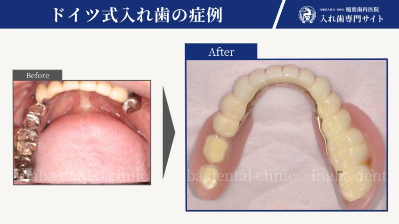 40代女性、奥歯が3本ない〜ドイツ式入れ歯で治療して11年経過しました〜