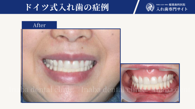 アメリカからの患者様、一時帰国3ヶ月集中治療をさせていただきました!