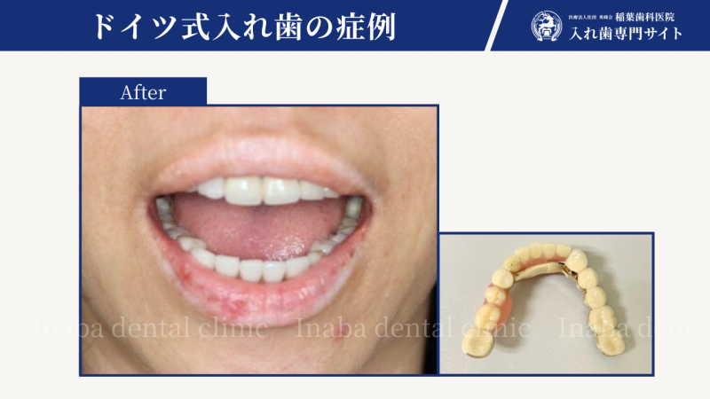 前歯が4本ない場合の治療方法について