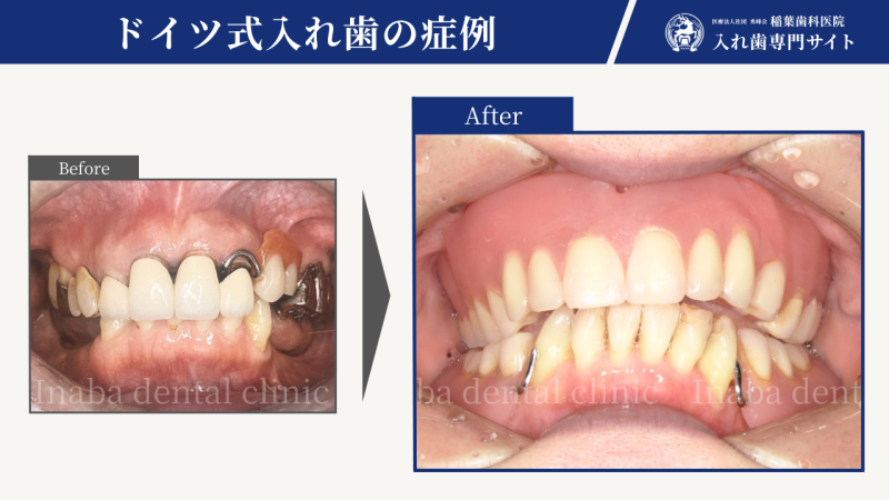 50代女性、全体的に歯がボロボロ、ドイツ式入れ歯で治療〜8年経過症例〜