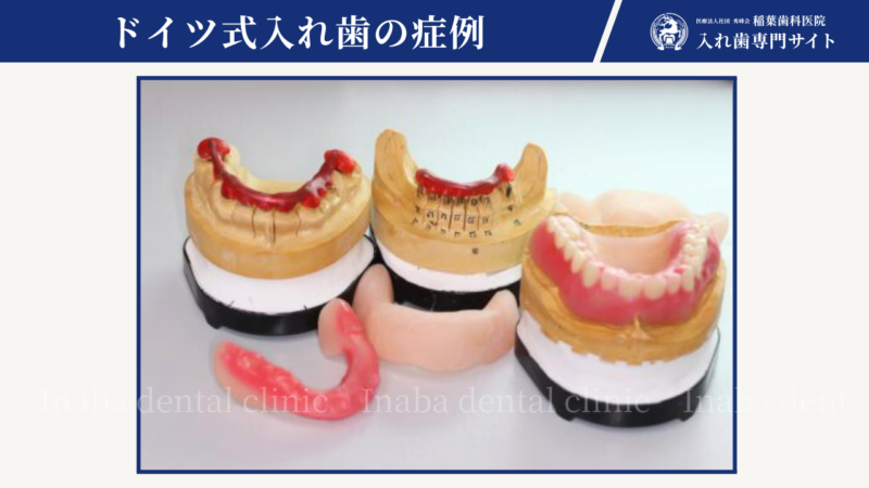 「全て歯を抜いてインプラントか総入れ歯」と言われた方の入れ歯治療