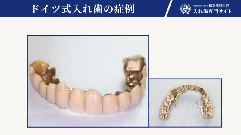 歯周病に有効な、ドイツ式入れ歯「リーゲルテレスコープ」17年経過しました