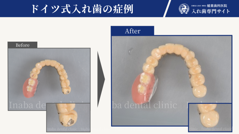 50代女性、8年経過症例のドイツ式入れ歯、メンテナンス修理について