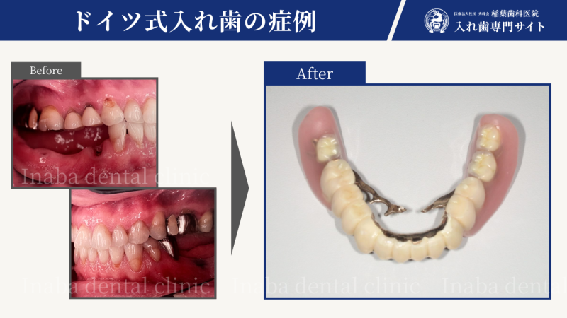 40代女性、両側奥歯が6本ない場合の部分入れ歯について