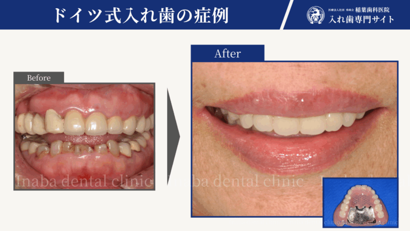 上あご奥歯がない方へ〜70代女性、ドイツ式入れ歯で治療〜