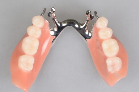 アメリカ発部分入れ歯、RPIクラスプデンチャー〜ドイツ式以外の選択肢〜