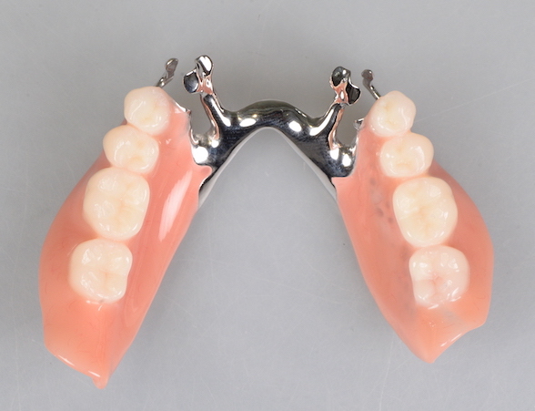 アメリカ発部分入れ歯、RPIクラスプデンチャー〜ドイツ式以外の選択肢〜