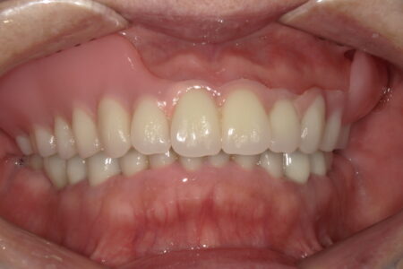 前歯だけ残っている場合の入れ歯治療について