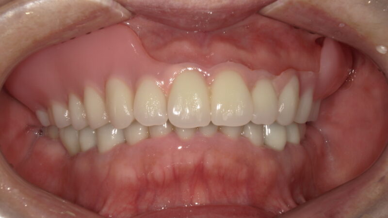 前歯だけ残っている場合の入れ歯治療について