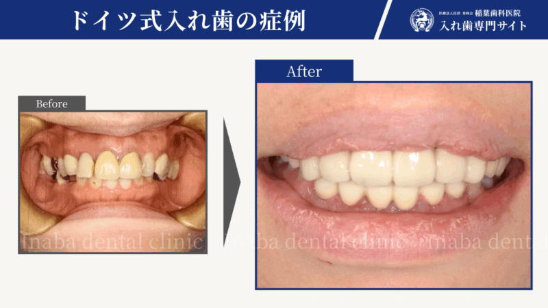 奥歯がなくても噛める選択肢があります~前歯6本で支えるドイツ式入れ歯治療~