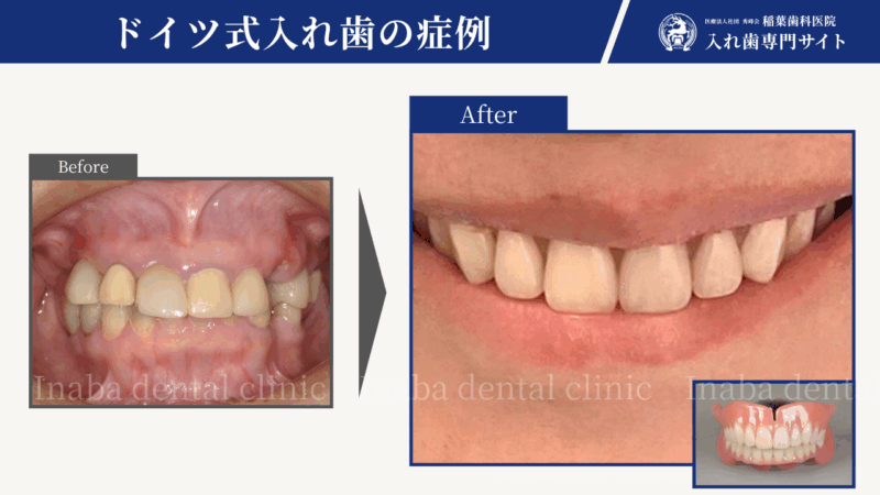 前歯がすぐ取れる・奥歯で噛めない40代女性のレジリエンツテレスコープ治療例