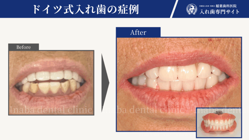 「入れ歯がすぐ外れる…」70代女性 6回の通院でしっかり噛める入れ歯治療
