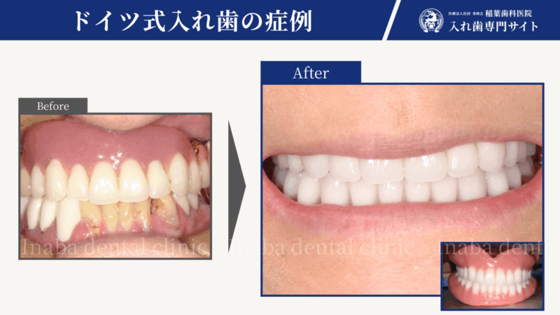 40代からの総入れ歯治療〜仮歯の2年間が教えてくれた、本当に大切なこと〜