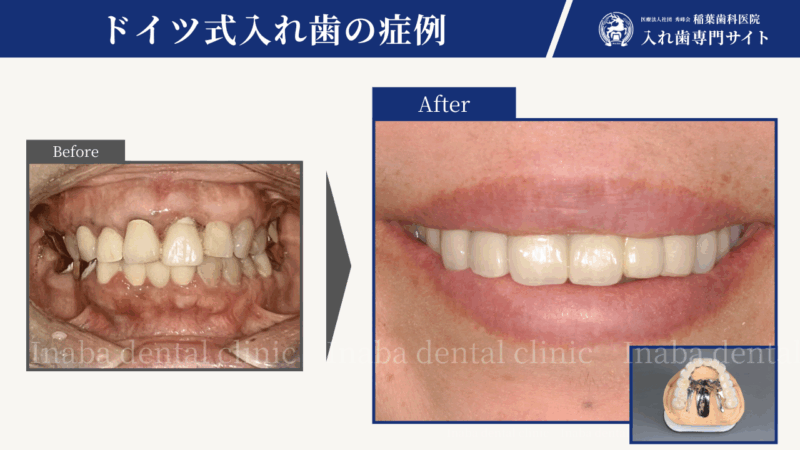 「全部治療した歯なのに噛めない」何度も治療してきたからこそ、丁寧に向き合った1年半