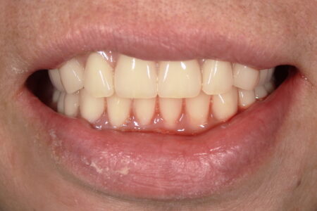 総入れ歯の仮歯(即時義歯)とは?抜歯後すぐに入れた72歳女性の体験①