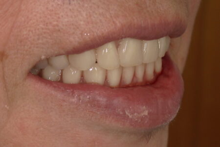 総入れ歯の仮歯は痛い?食べられない時期と慣れるまでの記録②